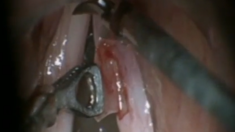 Resection vocal cord lesion with suture orientation