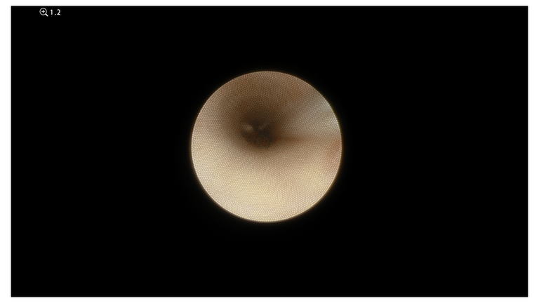 SMG cannulation with Prolene and 26 gauge angio