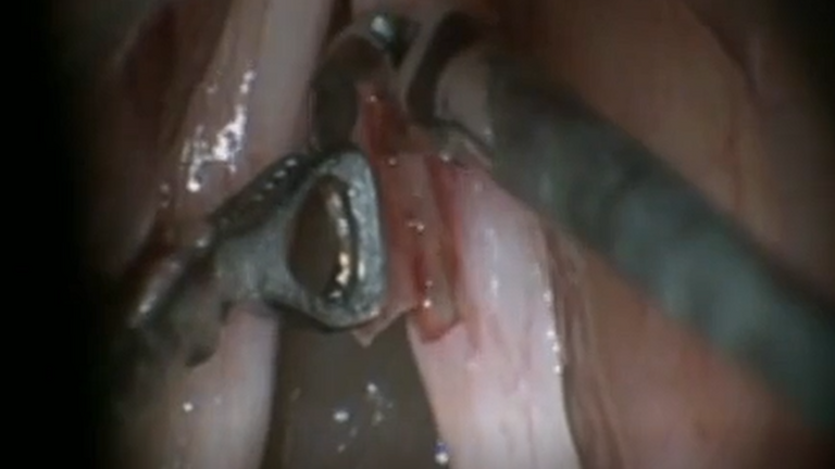 Resection vocal cord lesion with suture orientation
