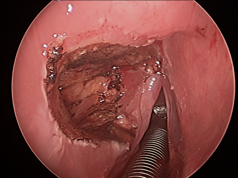 Intraop