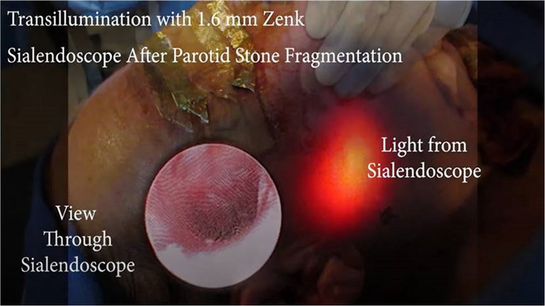 Parotid Sialendoscopy After Laser Lithotripsy