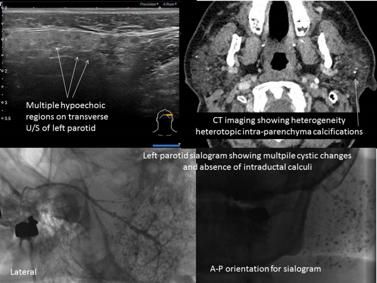 Correlation of ultrasound, sialogram and CT for patients with Sjogrens syndrome