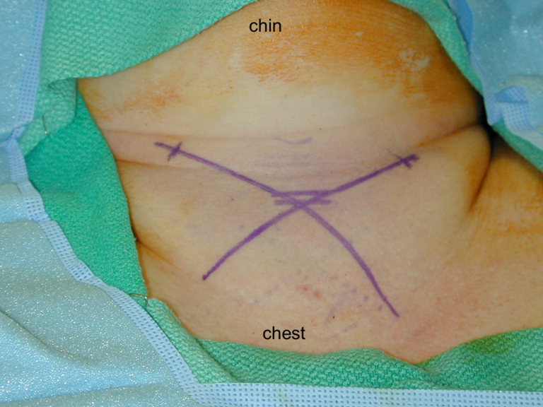 Incision for epithlial lined tracheostomy usually centered over cricoid