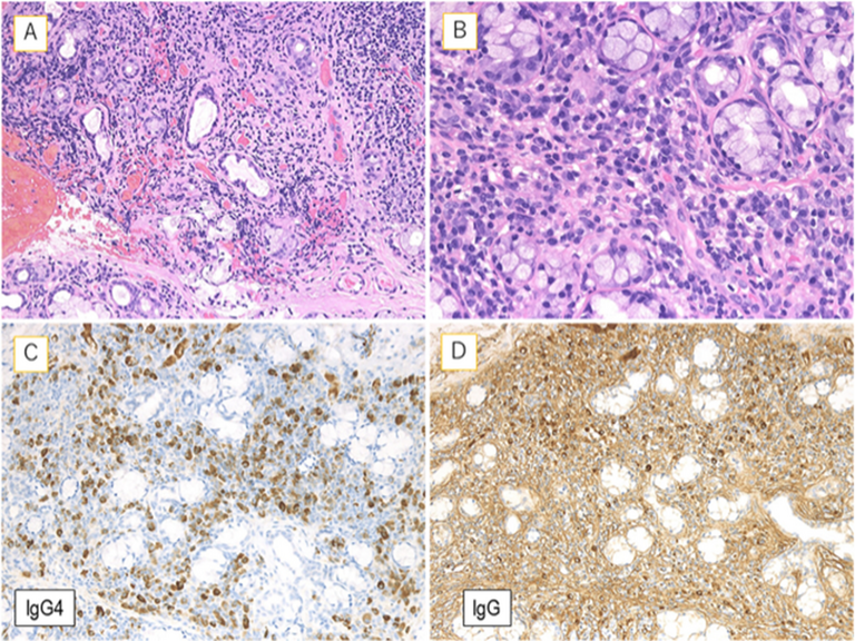 From "Application of Lip Biopsy for the Histological Diagnosis of Immunoglobulinavailable under the Creative Commons CC-BY-NC license and permits non-commercial use, distribution and reproduction in any medium, provided the original work is properly cited