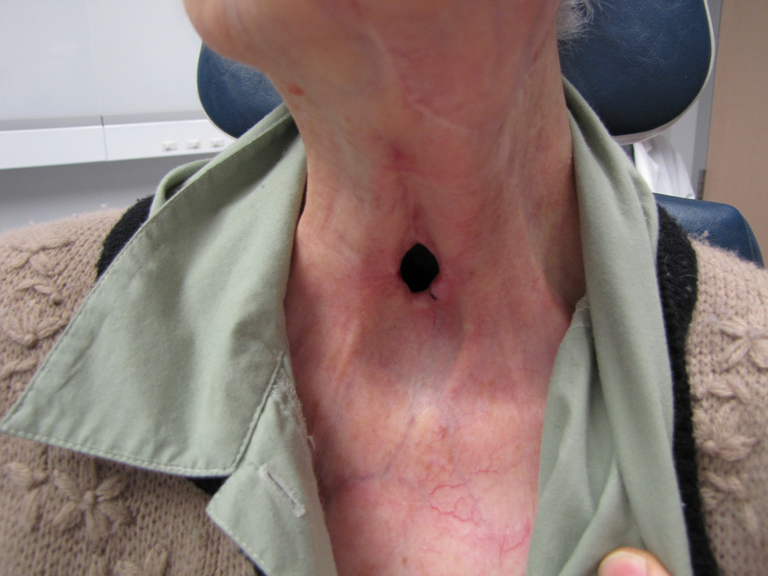 Near-Field Laryngectomy Sequence