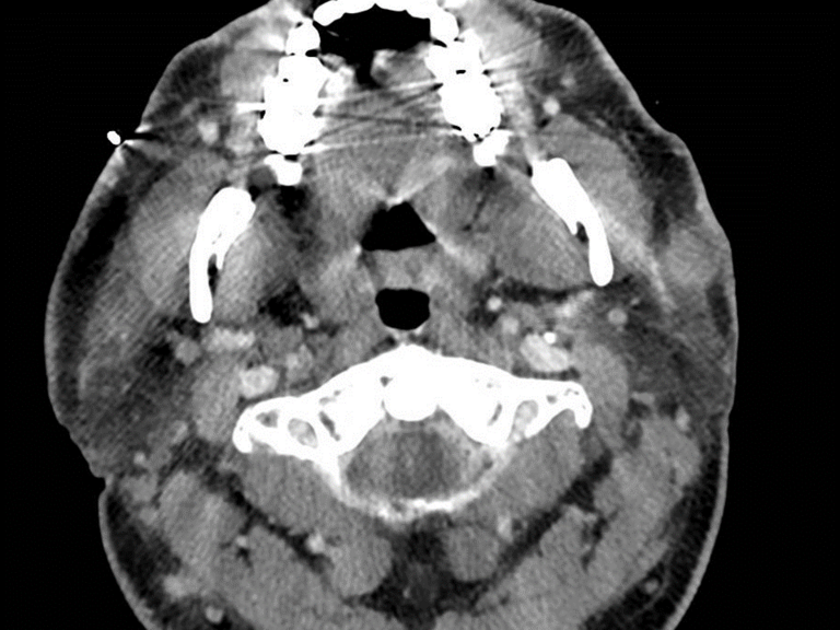 Lymphadenoma parotid
