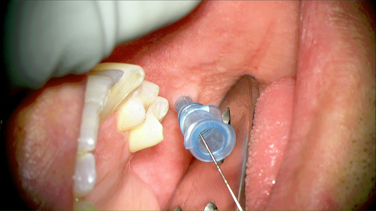 laser sialendoscopy for parotid stone