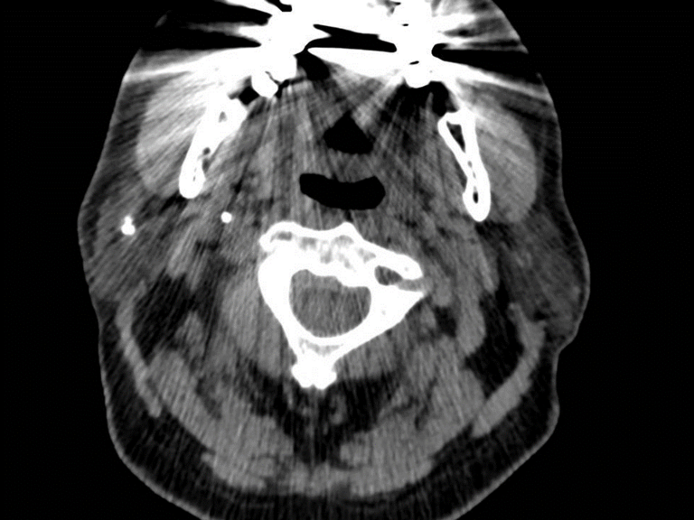 CT Parotid 4x5x4.4 mm stone   610 HU