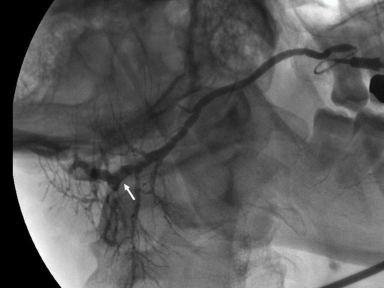 laser sialendoscopy for parotid stone