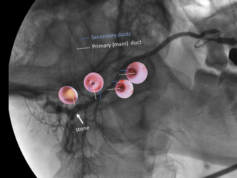 laser sialendoscopy for parotid stone
