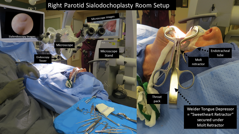 Parotid Sialodochoplasty Surgical Exposure - for Salivary Stone Removal