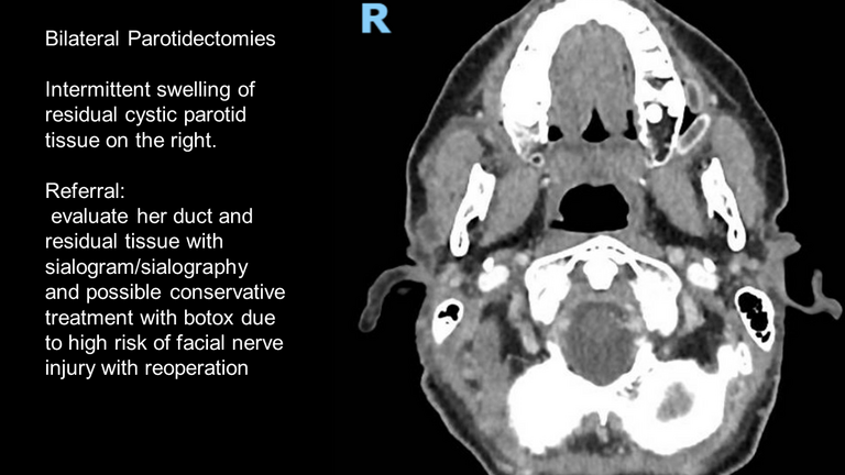 Botox® for sialadenitis after parotidectomy