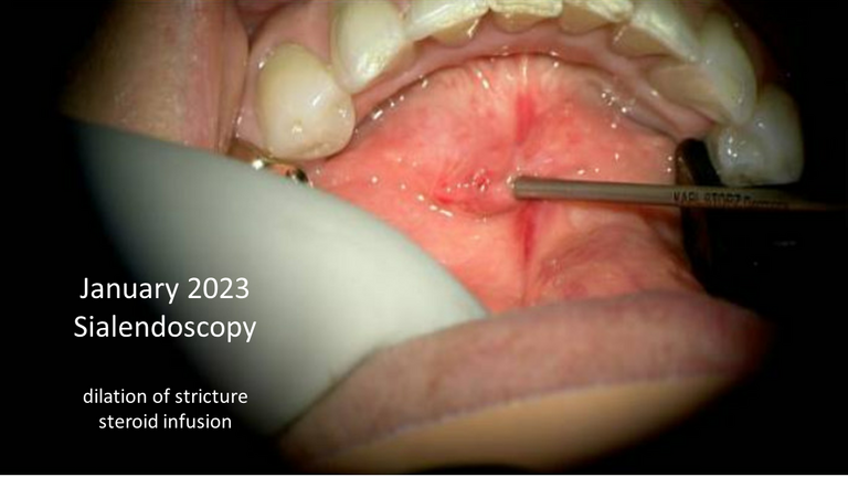 sialendoscopy smg stricture