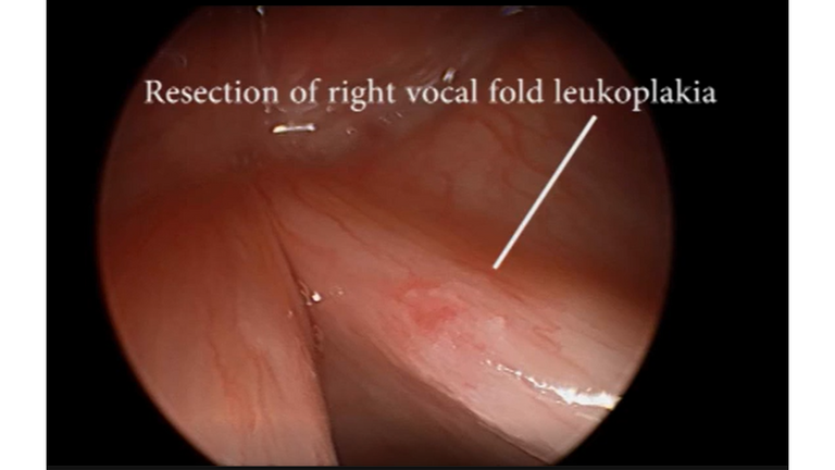 Resection vocal cord lesion with suture orientation