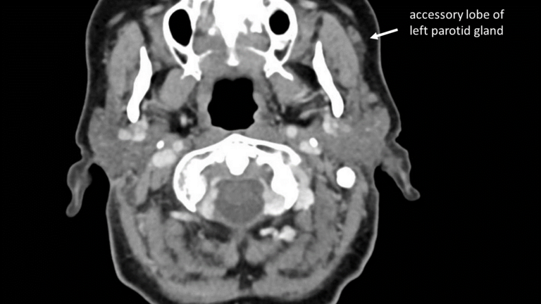 infusion of accessory lobe parotid sialography