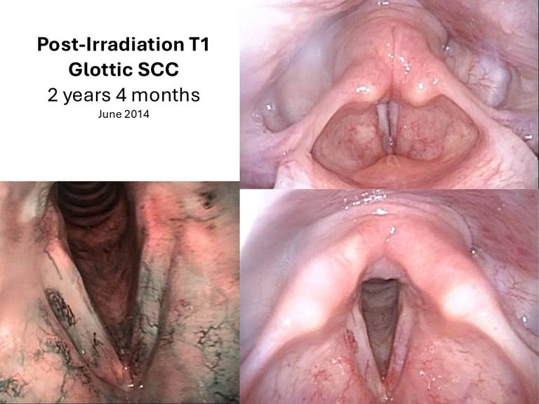 T1 post XRT long term sequence