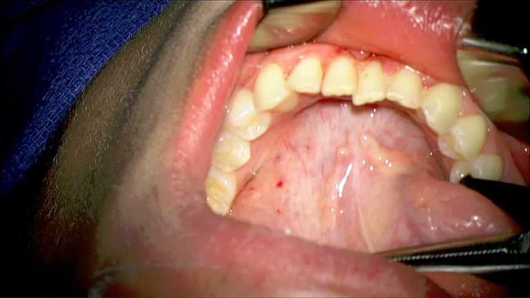 SMG cannulation with Prolene and 26 gauge angio