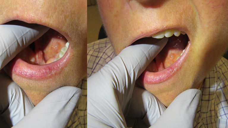 floor of mouth mucus retention cyst with rupture (mucus extravasation phenomenon).