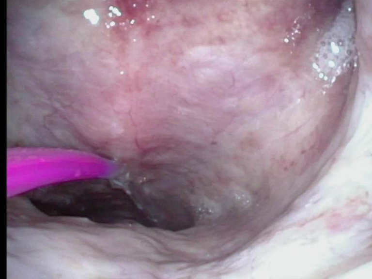 Imaging flexible distal chip laryngoscope through one nostril directs placment of balloon dilator through other