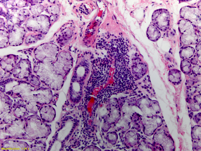 Inflammation in Sjogren syndrome can be centered around vessels as seen here
