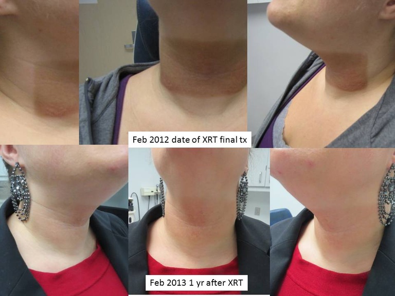 Appearance of neck on last day of irradiation and one year later