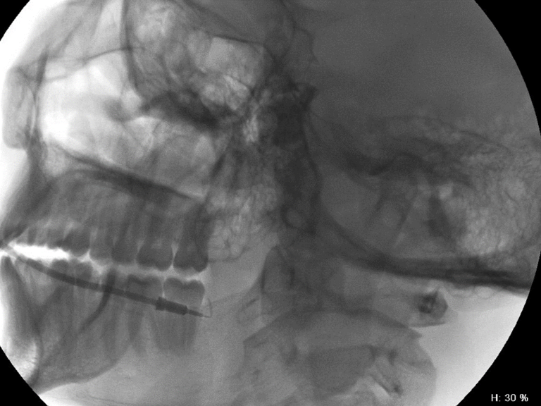 Left parotid duct cannulated with 22 gauge angiocatheter before contrast infusion (Isovue 370)