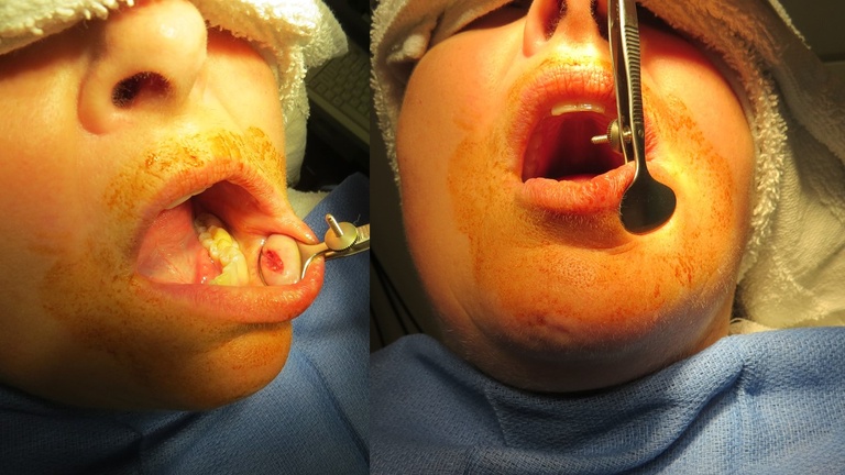 minor salivary gland biopsy of lip using chalazion clamp