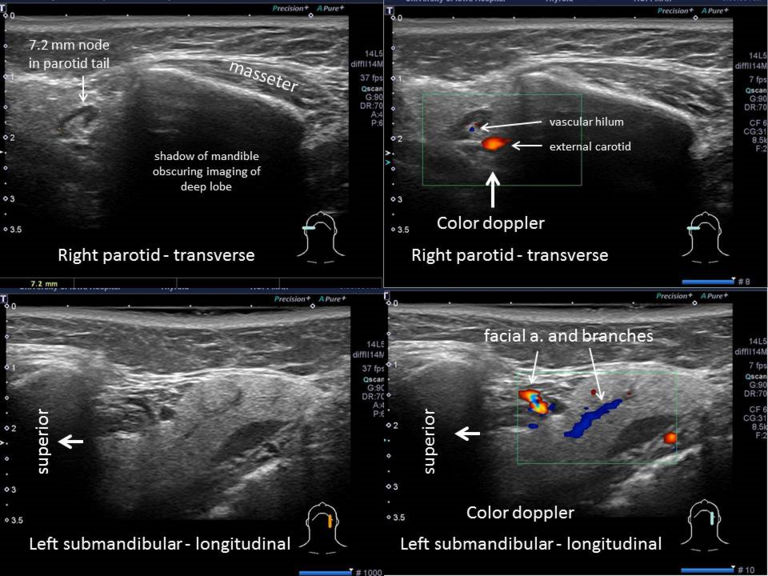 Color doppler aiding in identification of normal vascularity and lymph nodes