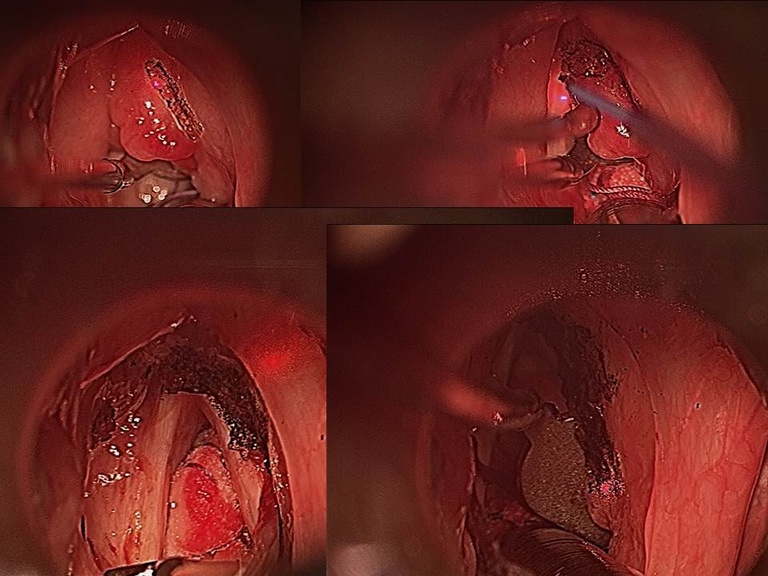 Excision of laryngeal mass
