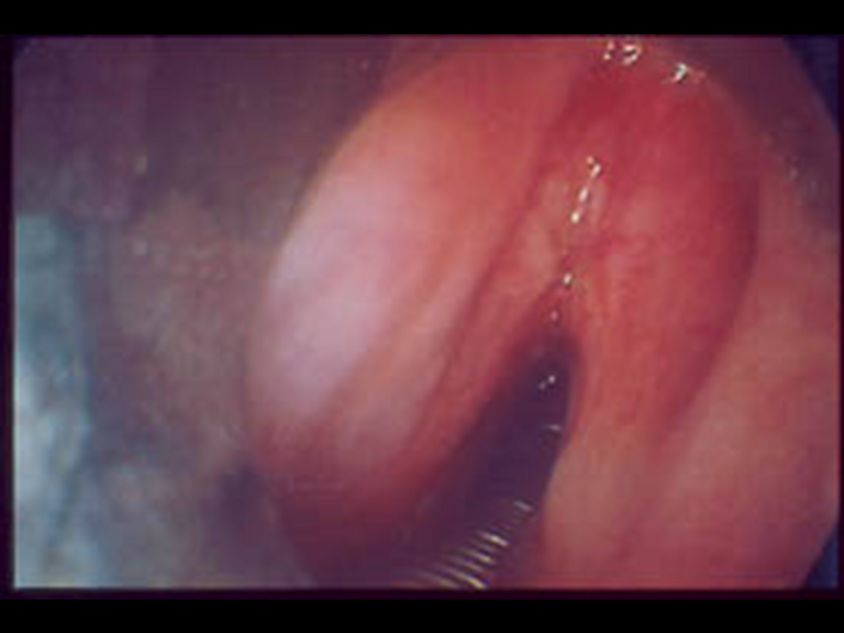 Endoscopic view of T1N0M0 SCC of anterior commissure