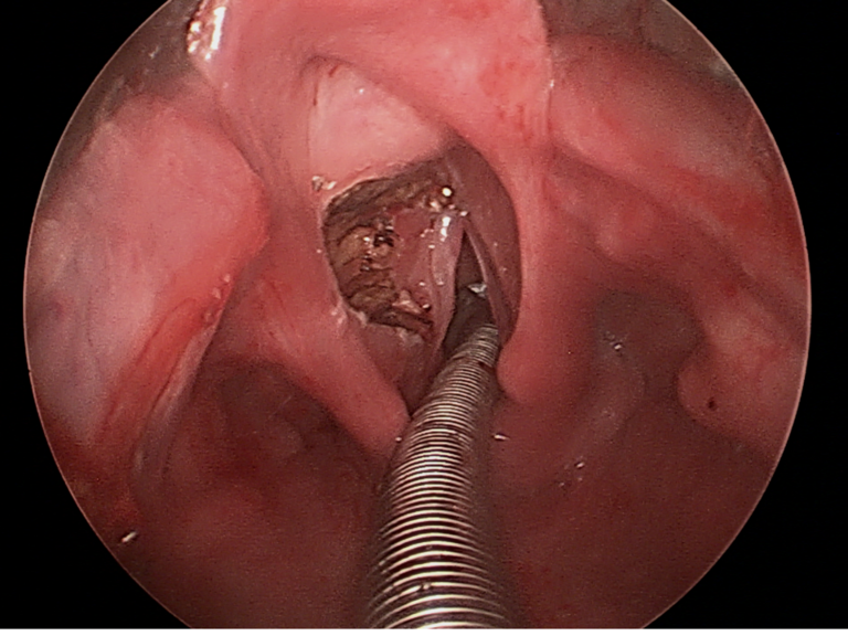 Intraop