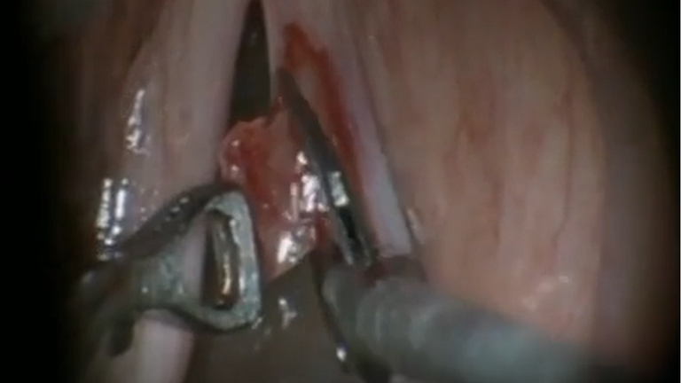 Resection vocal cord lesion with suture orientation