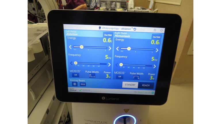 laser sialendoscopy for parotid stone