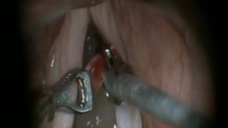 Resection vocal cord lesion with suture orientation