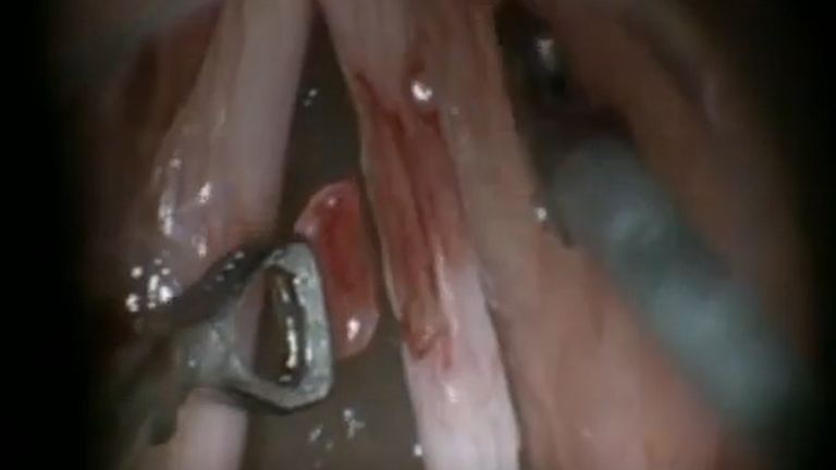 Resection vocal cord lesion with suture orientation