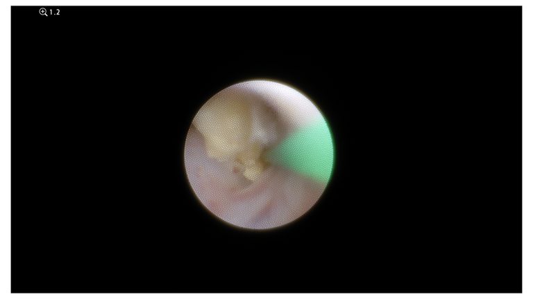 laser sialendoscopy for parotid stone
