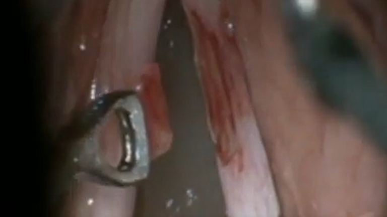 Resection vocal cord lesion with suture orientation