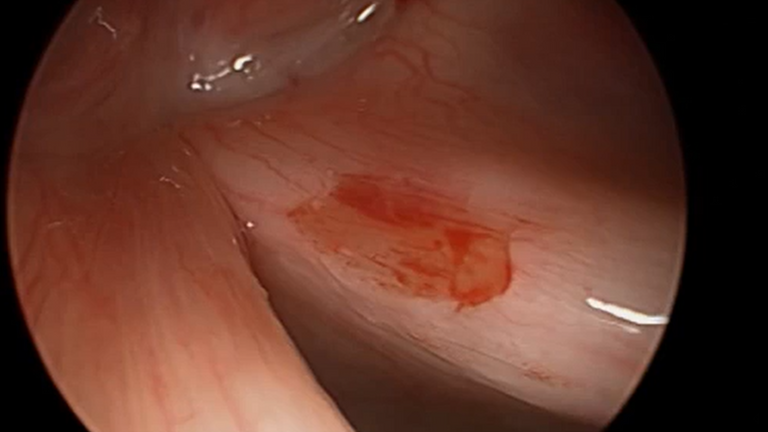 Resection vocal cord lesion with suture orientation