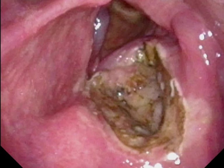Postop Day #1