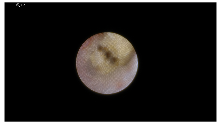 laser sialendoscopy for parotid stone