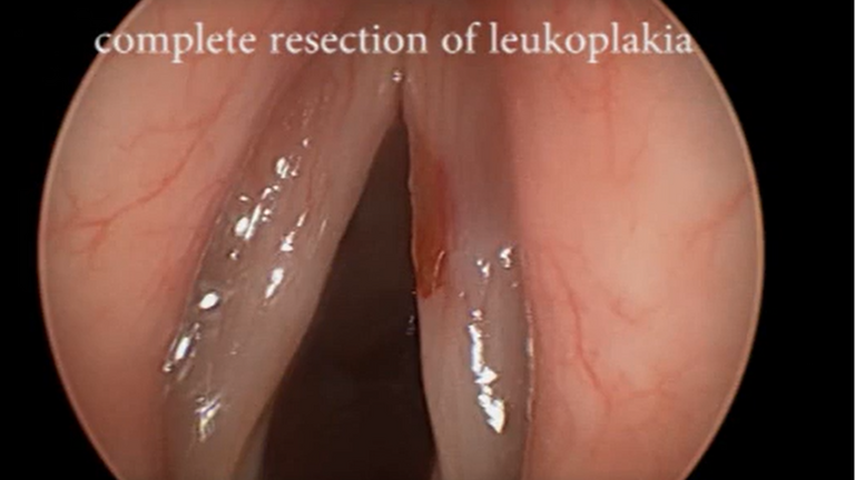 Resection vocal cord lesion with suture orientation