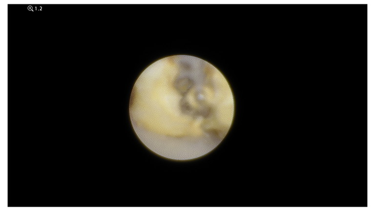 laser sialendoscopy for parotid stone