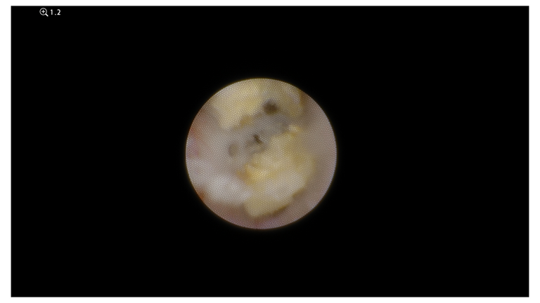laser sialendoscopy for parotid stone