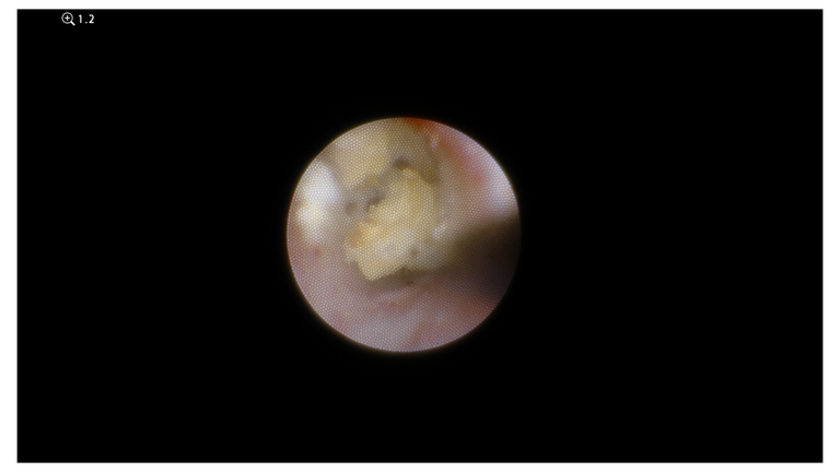 laser sialendoscopy for parotid stone