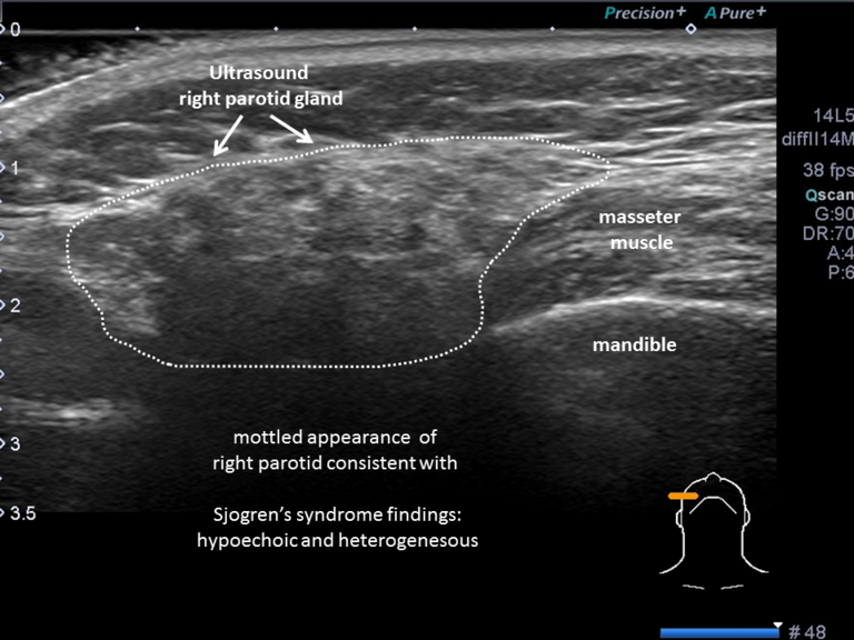Ultrasound shows right parotid to be hypoechoic and heterogeneous