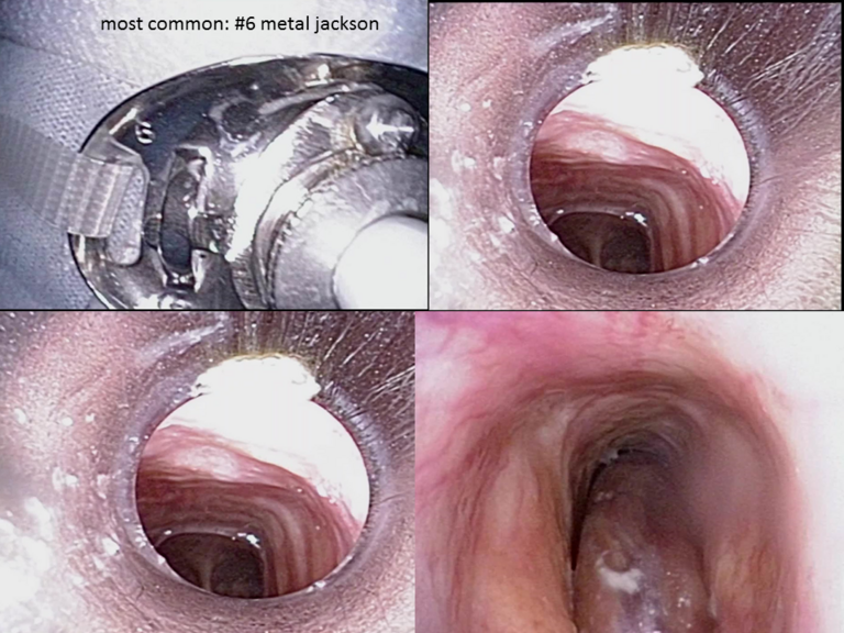 Standard metal #6 Jackson tracheostomy tube in place