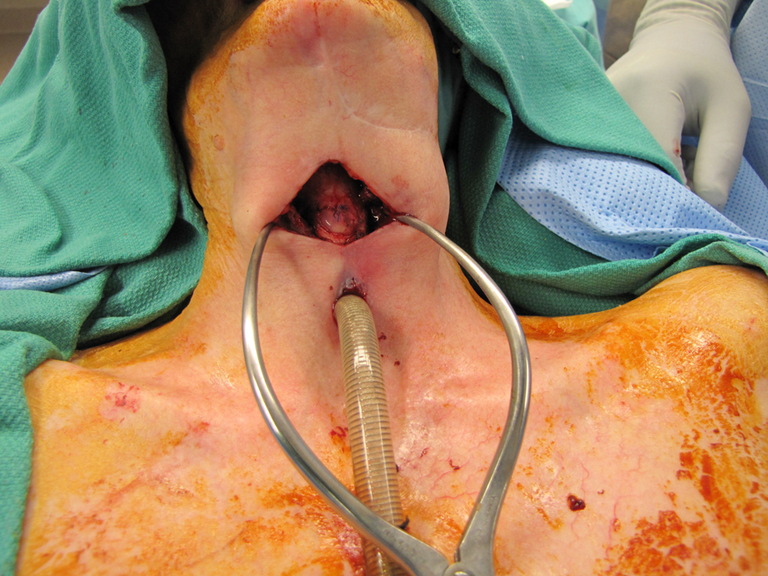 Near-Field Laryngectomy Sequence