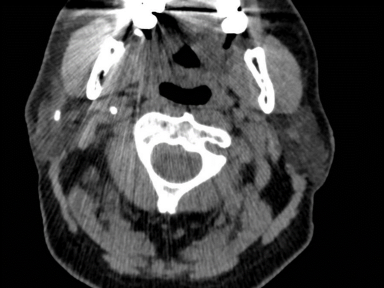 CT Parotid 4x5x4.4 mm stone   610 HU