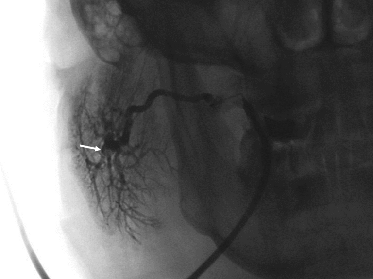 laser sialendoscopy for parotid stone