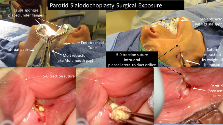 Parotid Sialodochoplasty Surgical Exposure - for Salivary Stone Removal